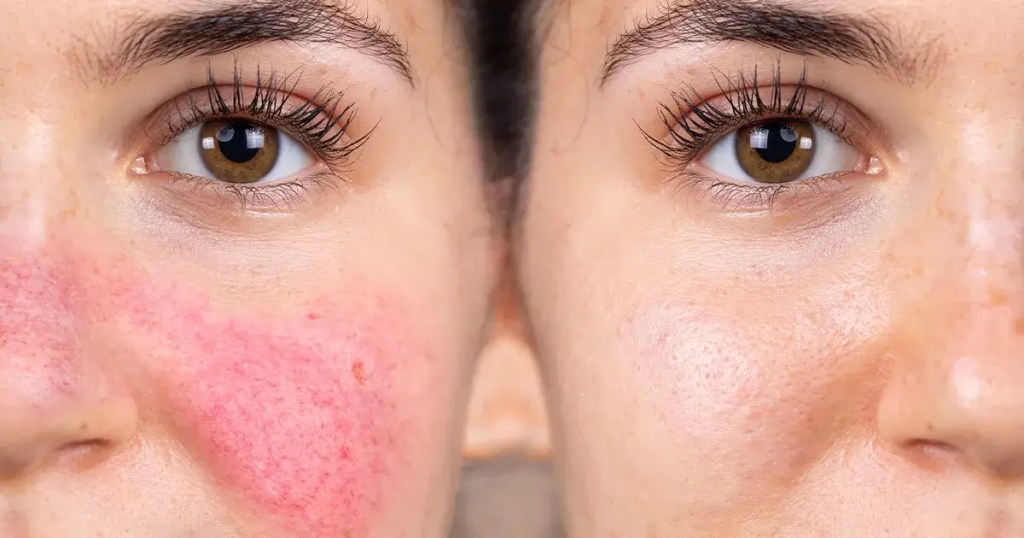 Before and after Rosacea
